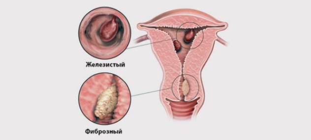 полипы в матке и беременность