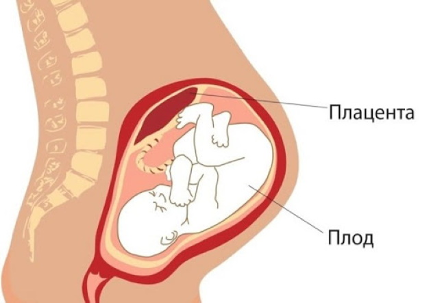 отслойка плаценты