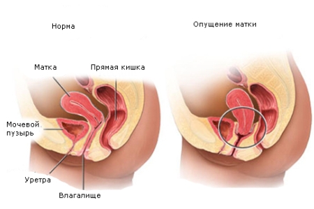 Схема опущения матки