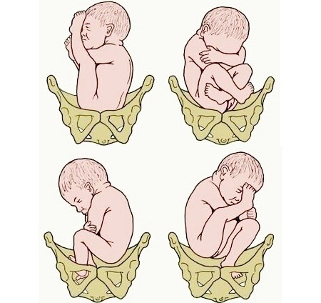 Схема предлежаний и положений плода