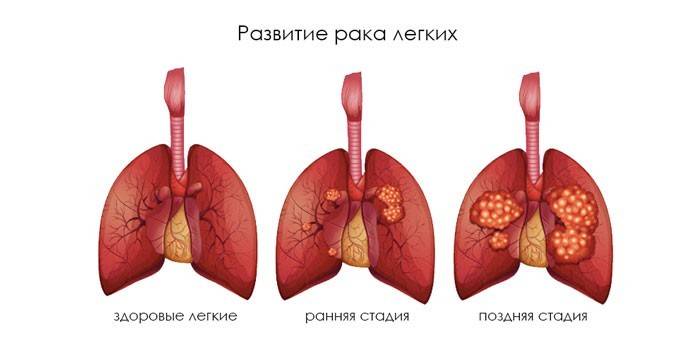 Медиастинальные лимфоузлы в легких